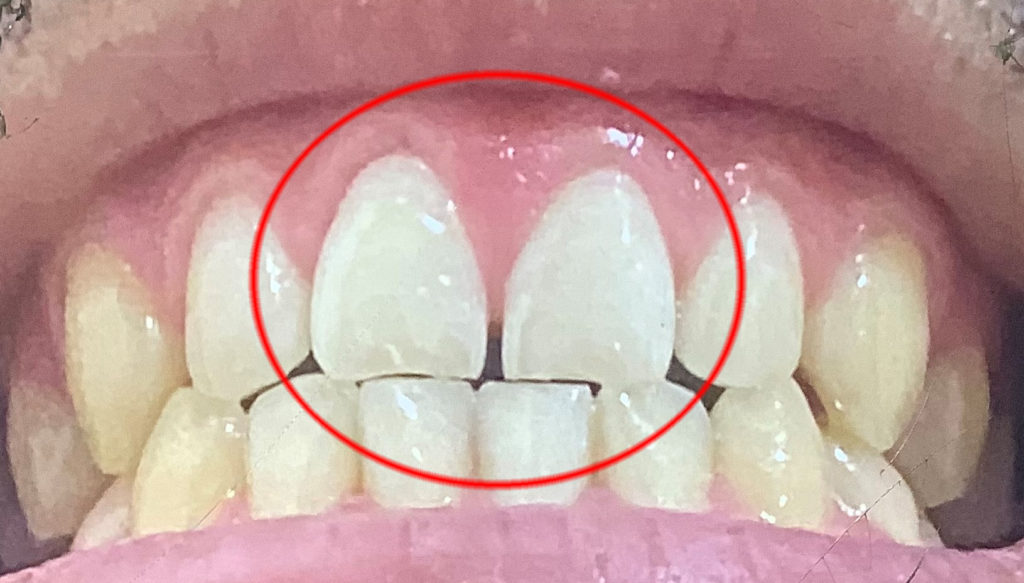 元々の前歯の隙間確認写真